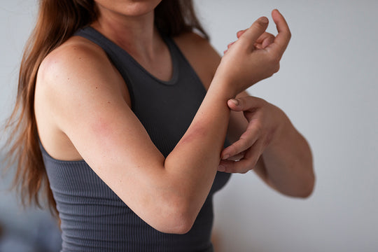 How to get Rid of a Rash Overnight