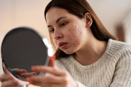 Rosacea, causes, symptoms and treatment
